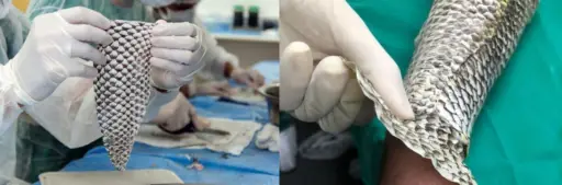 Piel de tilapia usada para persona con quemaduras